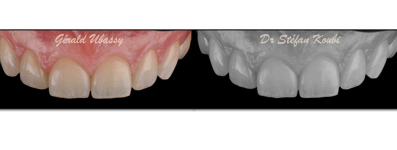 veneers and crowns /Dr Stefan Koubi